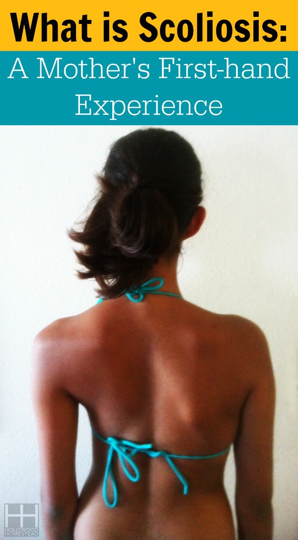 What is Scoliosis: A Mother’s First-Hand Perspective