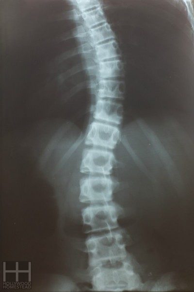 Scoliosis, with apex of thorax curve at Th8