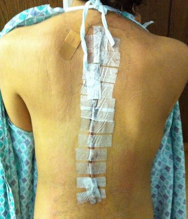 posterior scoliosis surgery