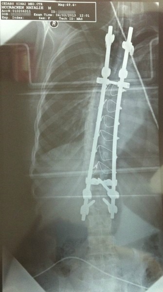 scoliosis x ray after